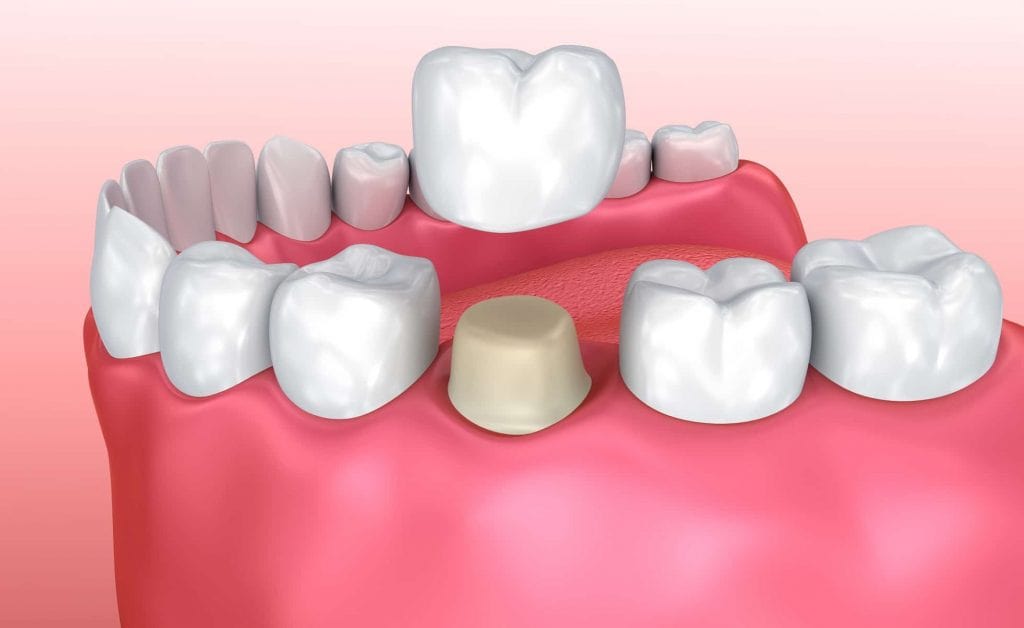 بیلداپ دندان