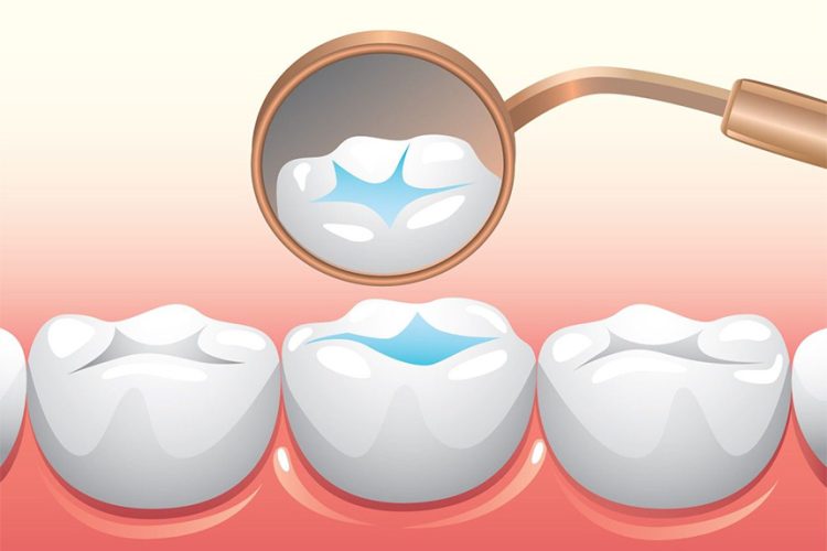 فیشور سیلانت یا شیار پوش دندان چیست؟