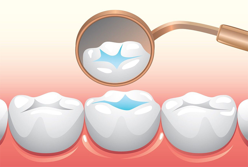 فیشور سیلانت یا شیار پوش دندان چیست؟