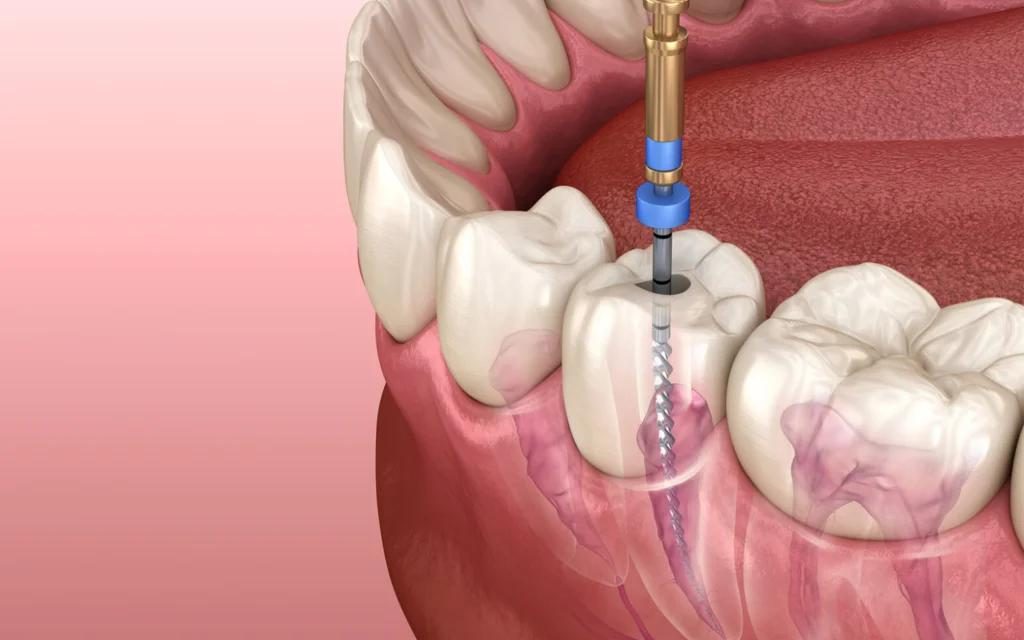 عصب کشی مجدد دندان چیست؟