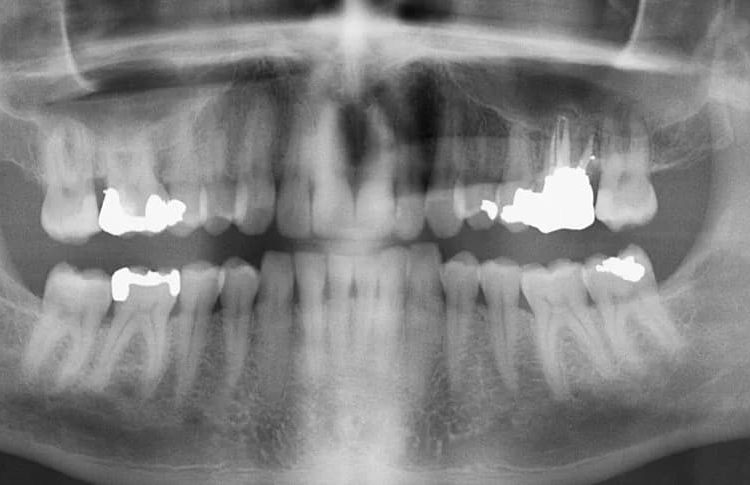 رادیولوژی و رادیوگرافی دیجیتال دندان (عکس OPG)